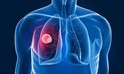 Akciğer Kanseri Belirtileri ve Tedavi Yöntemleri