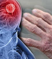Parkinson Hastalığı
